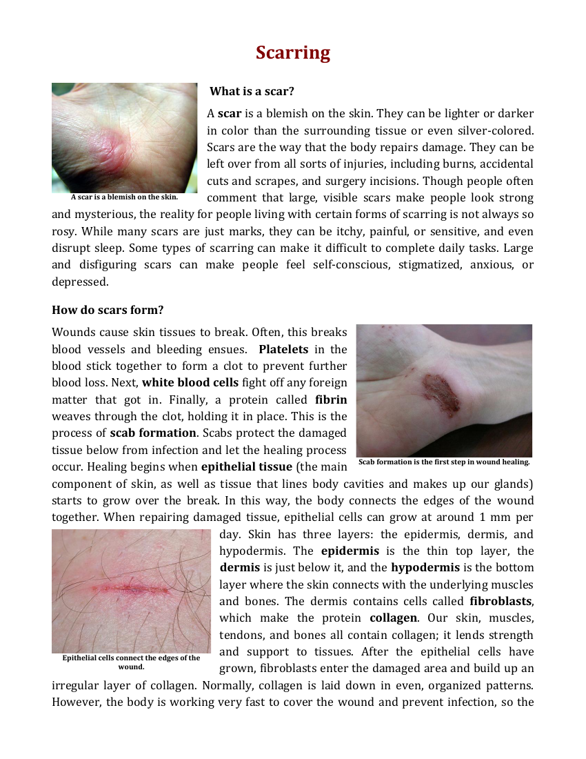 Integumentary System - Scarring Reading with Comprehension Questions